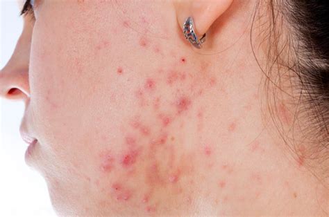 What Is Acne Fulminans With Pictures