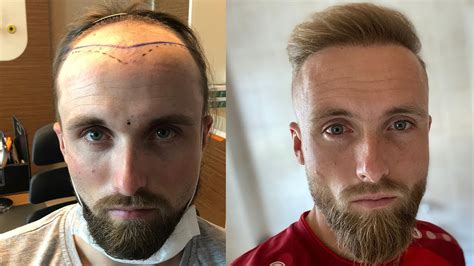 Hair Transplant Before And After Month By Month Results Elithair