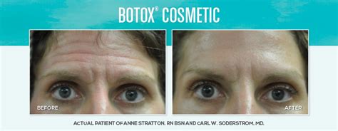 Botox Cosmetic Skin Dimensions Day Spa Medspa And Cosmetic Peoria Il