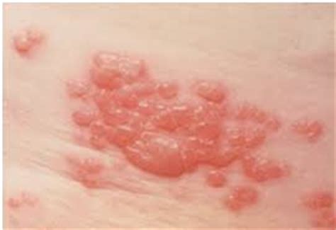 What Is Shingles? | Healthcare-Online