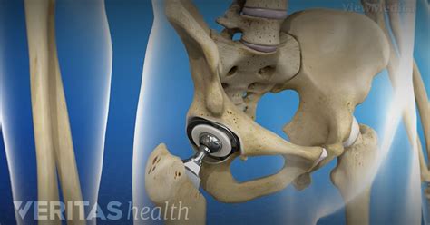 Pin On Hip Replacement Surgery