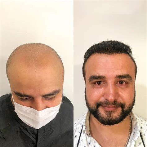 FUE Sapphire Hair Transplant Ilyas Arslan Hair Clinic