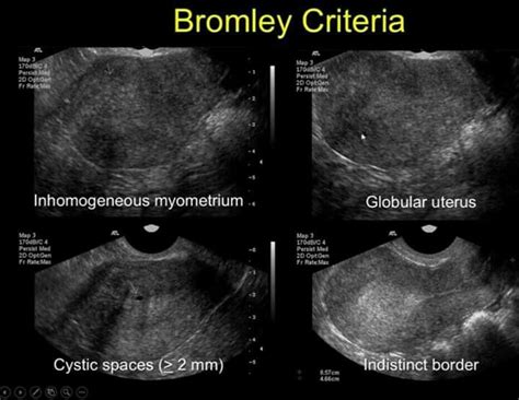 Ectopic endometrial gland tissue vs tissue in uterine musculature. ADENOMYOSIS | Medical ultrasound, Radiology imaging ...