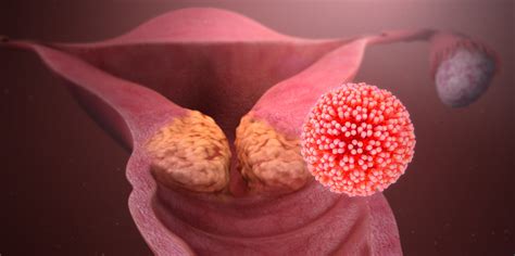 Updated hpv vaccination recommendations of the advisory committee on immunization practices. Hpv virus ansteckung frau mann, WIE AUCH IMMER. Oricum o ...