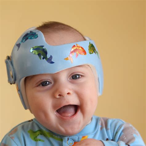 Why Plagiocephaly Flattening Of The Head Happens And What To Do About