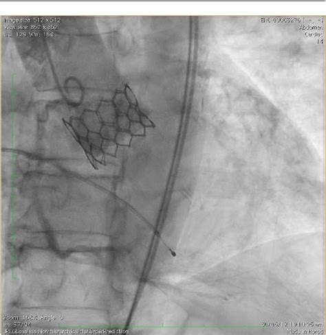 Figure 1 From The Myval Transcatheter Heart Valve System For The