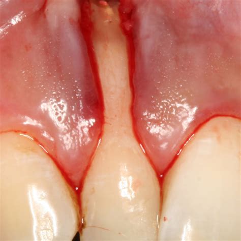PDF Treatment Of An Advanced Gingival Recession Involving The Apex Of