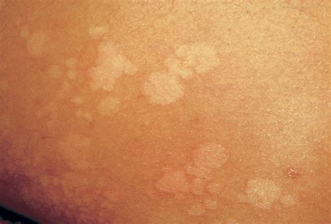 Tinea versicolor is a common fungal skin infection which produces a characteristic rash. Rencic Dermatology | Tinea Versicolor