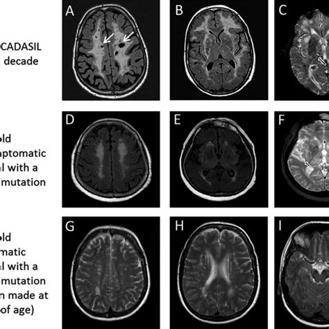 Brain Mri Of Elderly Asymptomatic And Paucisymptomatic Individuals With