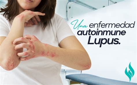 Lupus Una Enfermedad Autoinmune Centro Clínico Fenix Salud