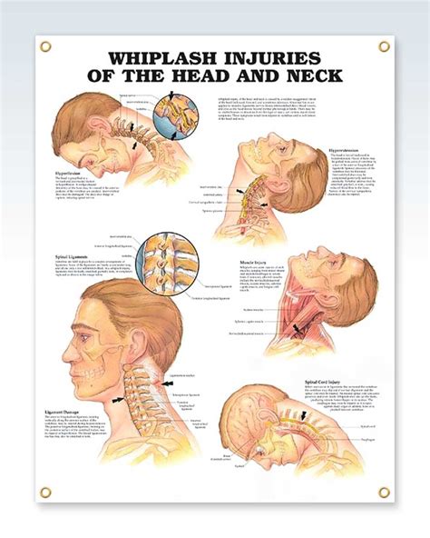 Whiplash Injuries Of The Head And Neck Exam Room Anatomy Poster