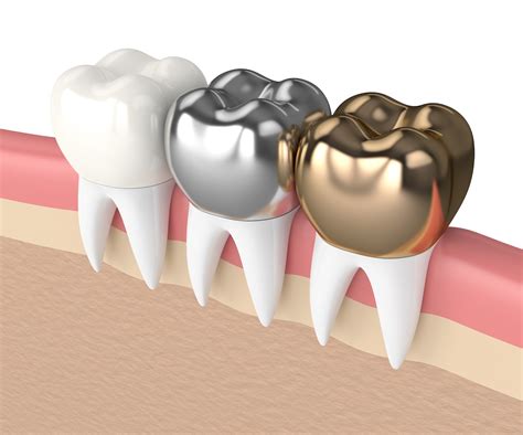 Silver Tooth Crowns Benefits Treatment Side Effects And Cost