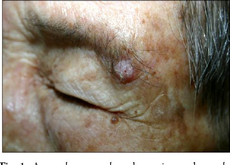 Figure 1 From A Case Of Acantholytic Squamous Cell Carcinoma