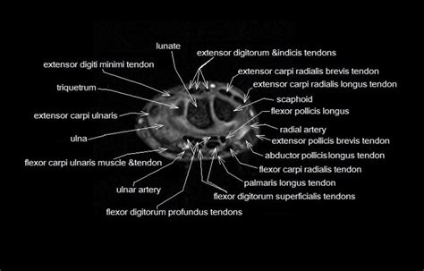 Wrist Anatomy Mri Wrist Axial Anatomy Free Cross Sectional Anatomy