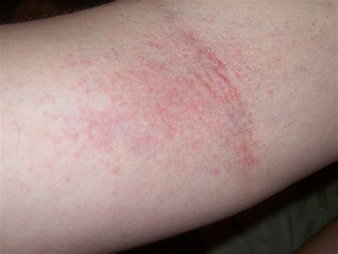 Red Splotches On Arm Pictures Photos