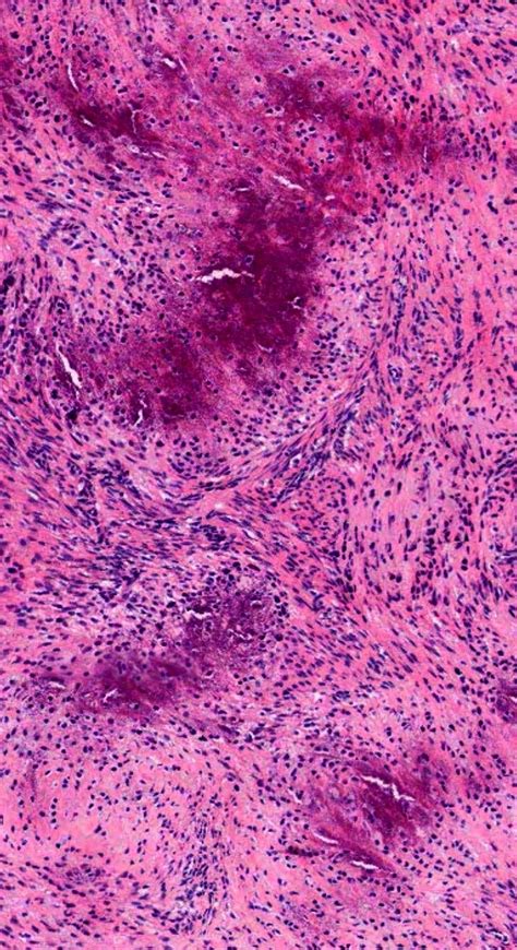 Pathology Of Calcifying Aponeurotic Fibroma Microscopic Images Case