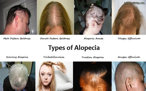 What Is Alopecia Areata Causes Types Treatment Of Alopecia