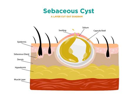 Scrotal Sebaceous Cyst