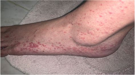 Purpuric Rash On The Dorsa Of The Feet Of A Patient Hospitalised For A