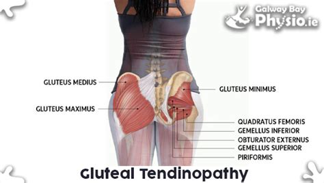 Gluteal Tendinopathy Galway Bay Physio