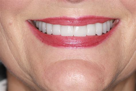 chicago cosmetic dentist gives me smile back with porcelain veneers in chicago