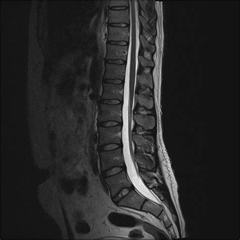 Mri Lumbar Spine Scan Sagittal View Lumbosacral Spine Has Straightening