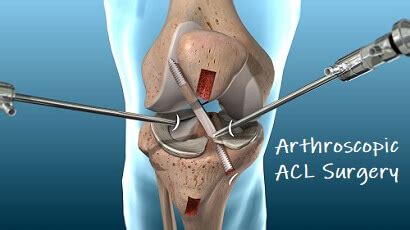 Arthroscopic ACL Surgery Knee Pain Explained