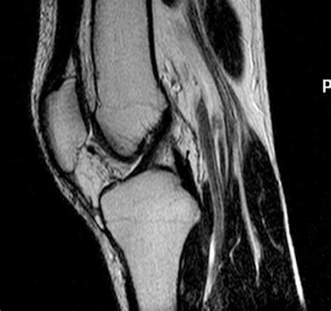 Anterior Cruciate Ligament Acl Sagittal Oblique T2 Fse Image