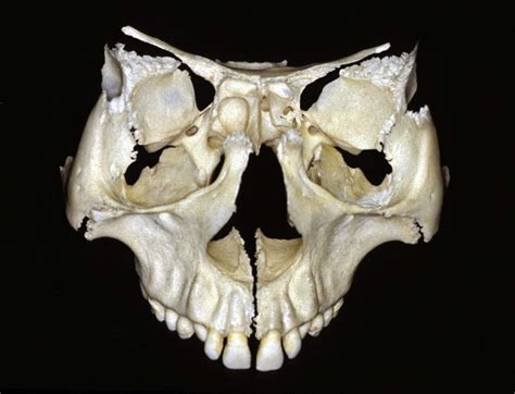 Anterior View of Sphenoid, Zygomatic, and Maxilla Bones | Neuroanatomy