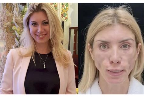 With Plastic Surgery Gone Wrong Russian Beauty Queen Left Disfigured