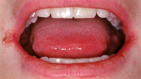 Lips Cracking In Corners Vitamin Deficiency