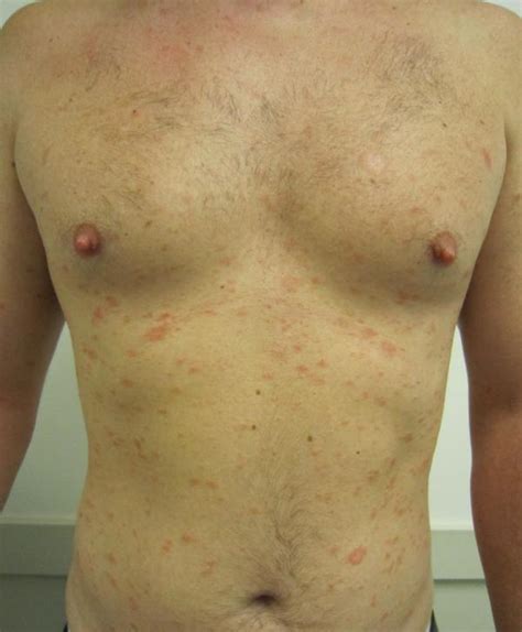Pityriasis Archives Page 4 Of 5 Medical Information