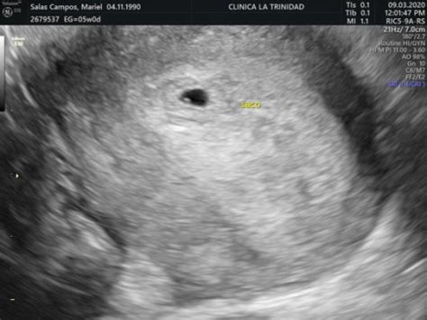 Saco Gestacional Pequeño Embarazadas Primerizas Página 2