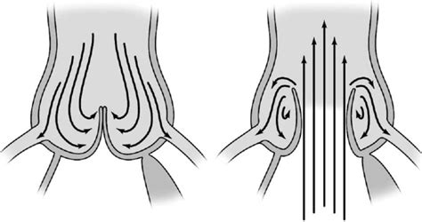 The Aortic Sinuses Form An Integral Part Of The Normal Aortic Valve