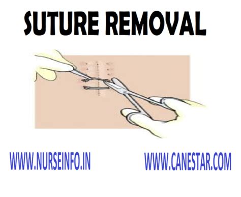 Suture Removal Nurse Info