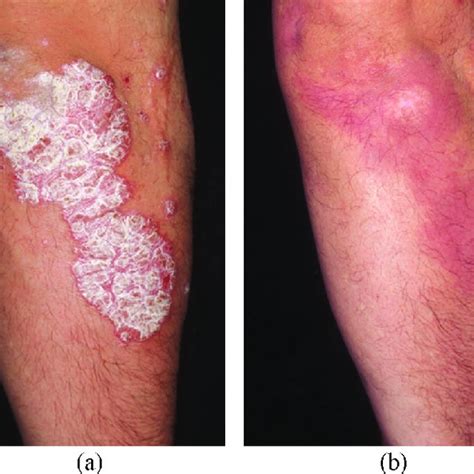 Plaque Psoriasis Vulgaris A Before And B After Combined Cryogenic