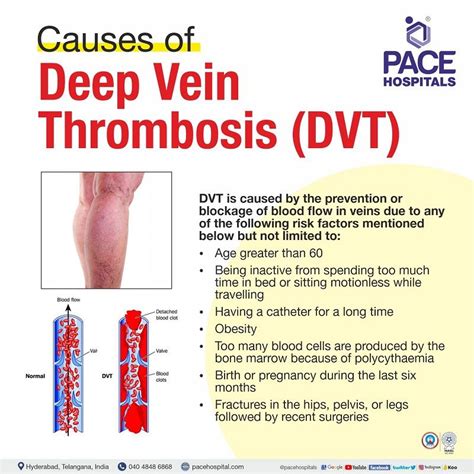 Deep Vein Thrombosis Dvt Symptoms Causes And Complications