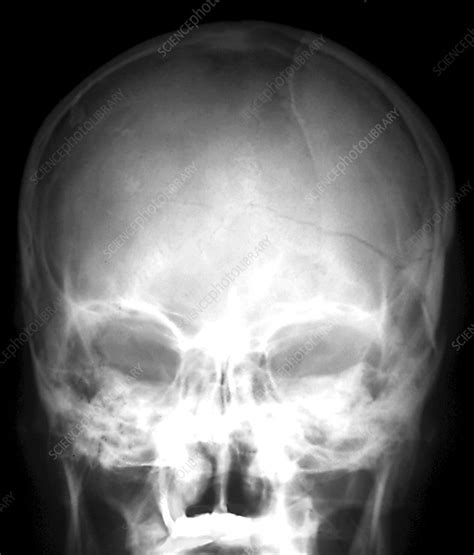 Skull Fracture X Ray Stock Image C0403078 Science Photo Library