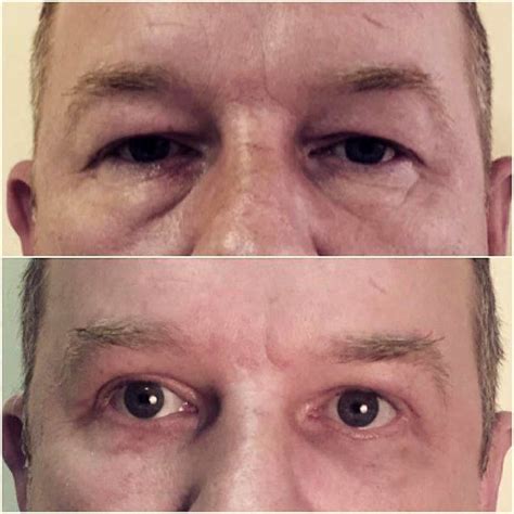 Before And After Blepharoplasty Upper Eyelid In Nyc Picture Removal
