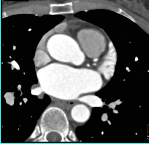 Normal Appearance Of The Left Atrial Appendage Cardiac Case Studies