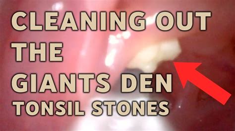 Removing Giant Tonsil Stones Aim 13 Youtube