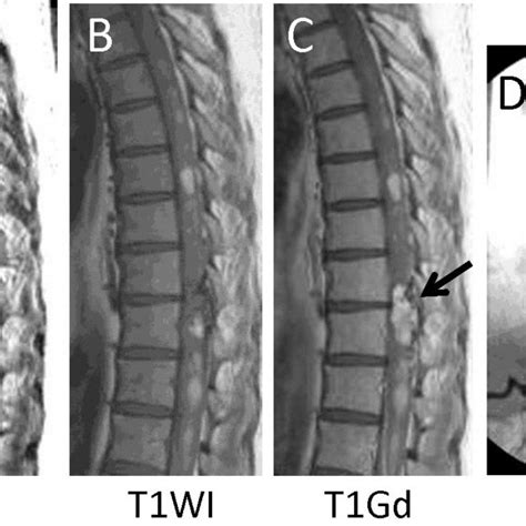 Preoperative Imaging Magnetic Resonance Mr Imaging Of The Spinal
