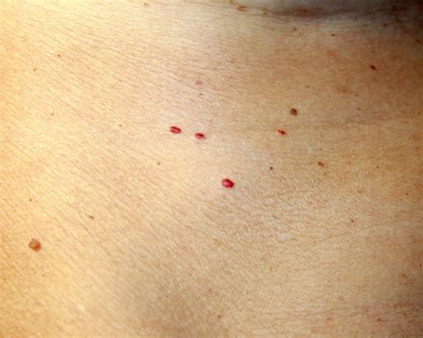 A Quick Way To Get Rid Of Cherry Angiomas Red Moles At Home Venusianglow