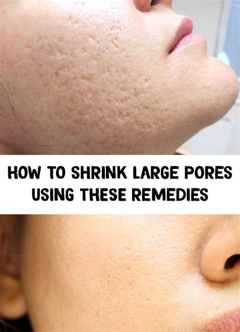 How To Shrink Large Pores Using These Remedies Large Pores Shrink