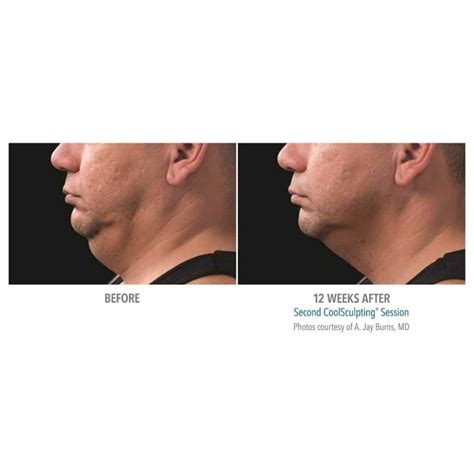 Double Chin Reduction At Sculpted Contours In Alpharetta Ga