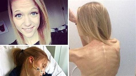 Una Joven Cae En La Anorexia Inspirada En Selfies Que Muestran La