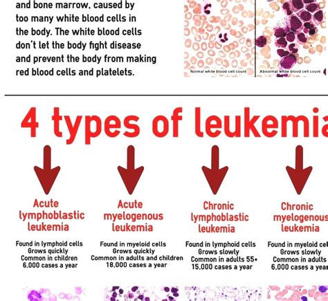 Leukemia And Lymphoma Society Leukemia Non Profit Organizations