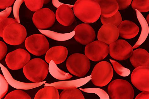 A person with just one copy of the mutated gene is said to have the sickle cell trait. Sickle Cell Disease Treatment Options - MDNewsline