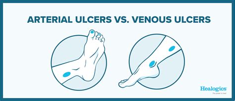 Arterial Vs Venous Ulcers What Are The Differences
