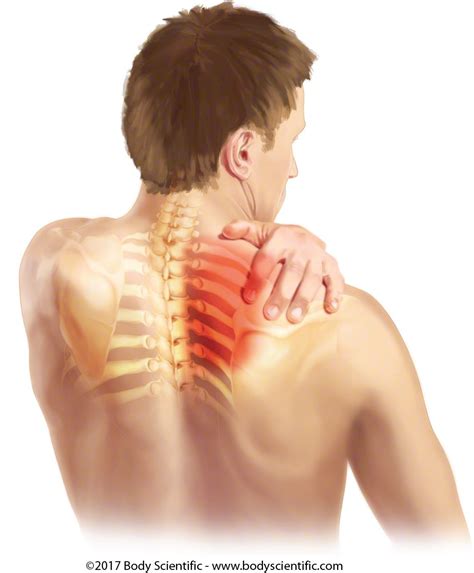 Neck Pain Upper Back Pain Shoulder Pain Could It Be Thoracic Outlet